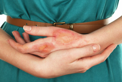 Burn Injuries can lead to a life of treatment and painful rehabilitation