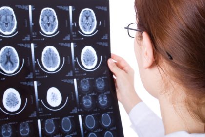 ​Can a Car Accident Cause Brain Injury? 